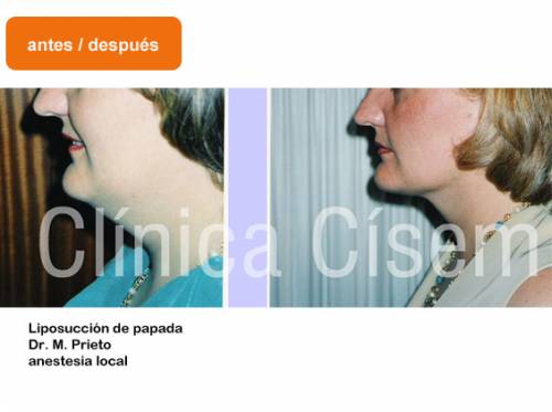 Liposucci�n de papada
